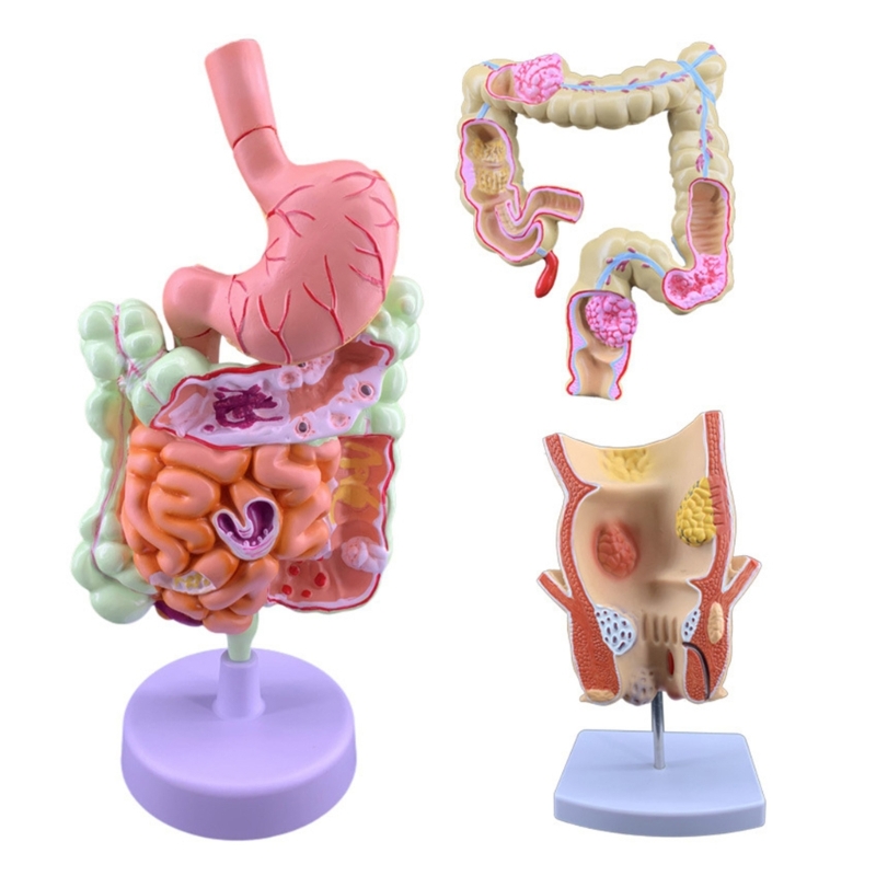 Medical Lab Observer - Q6PA 3D Pathologie-lesmodel, PVC-anatomiedisplay voor laboratoriumobservatie,